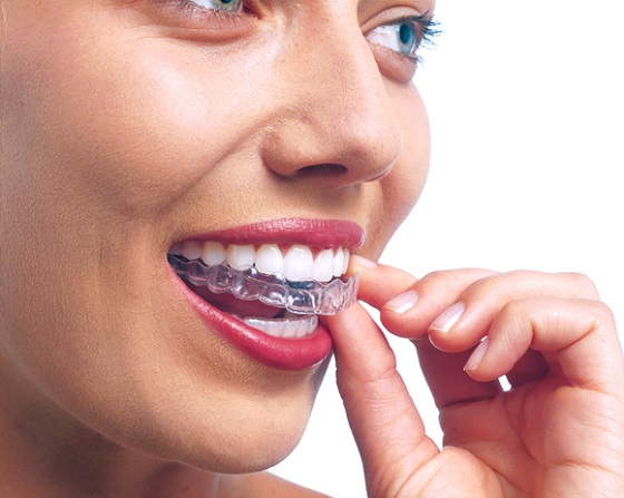 what-is-invisalign1